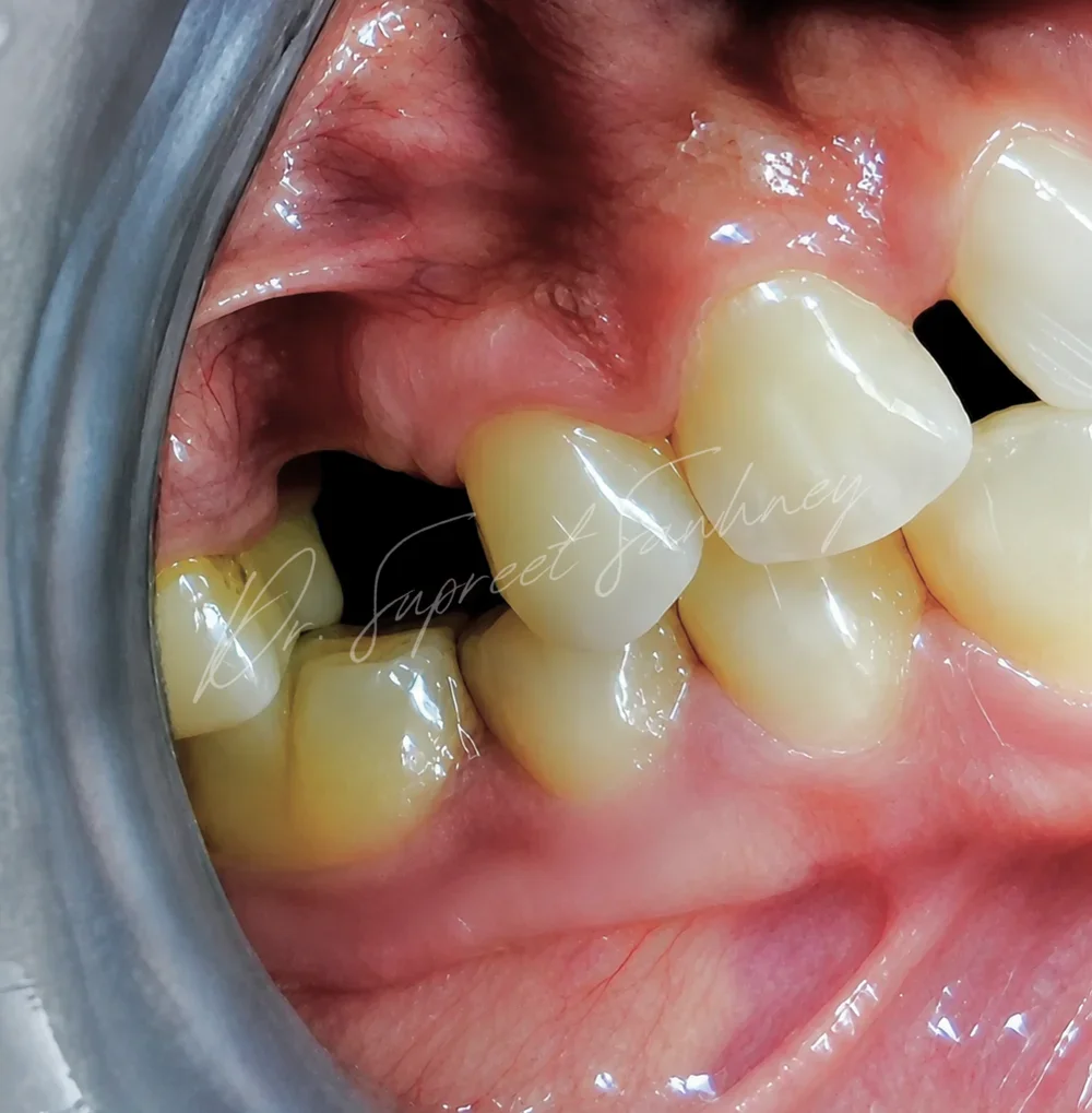 Lateral intraoral photograph of the posterior maxillary implant restoration